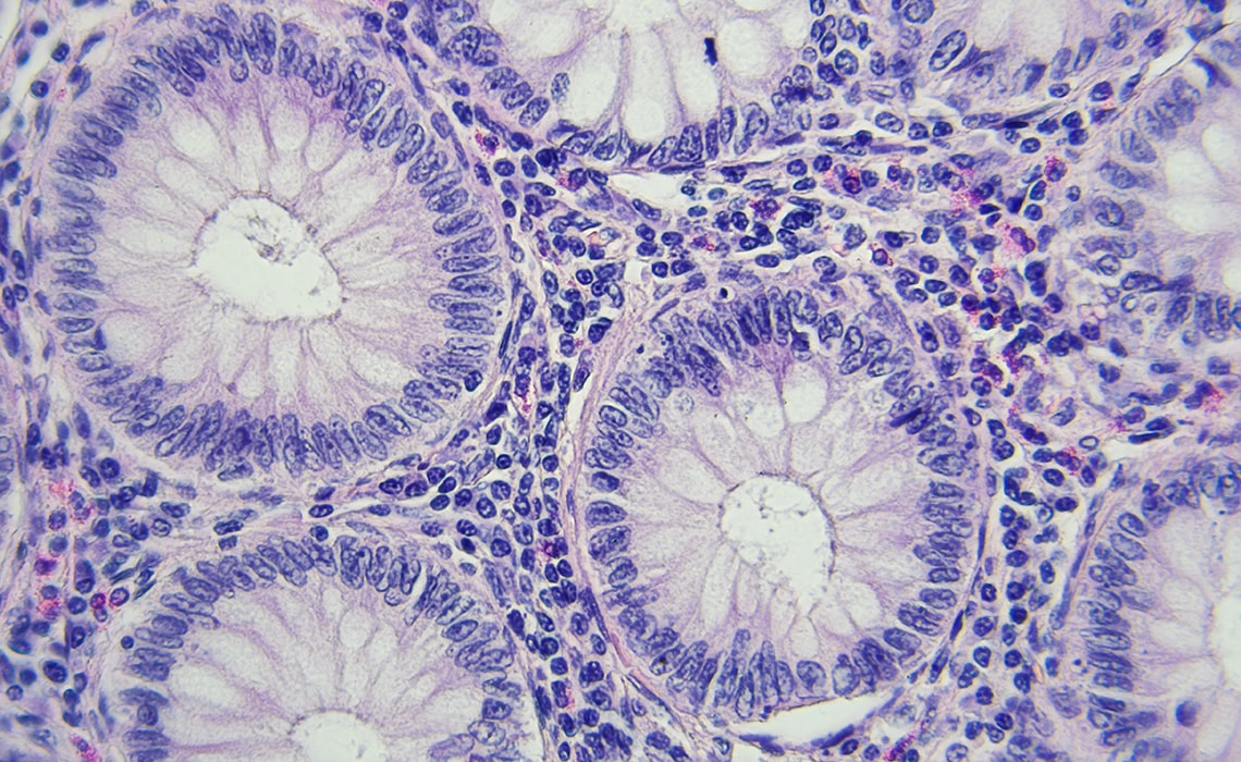 Cancer cells